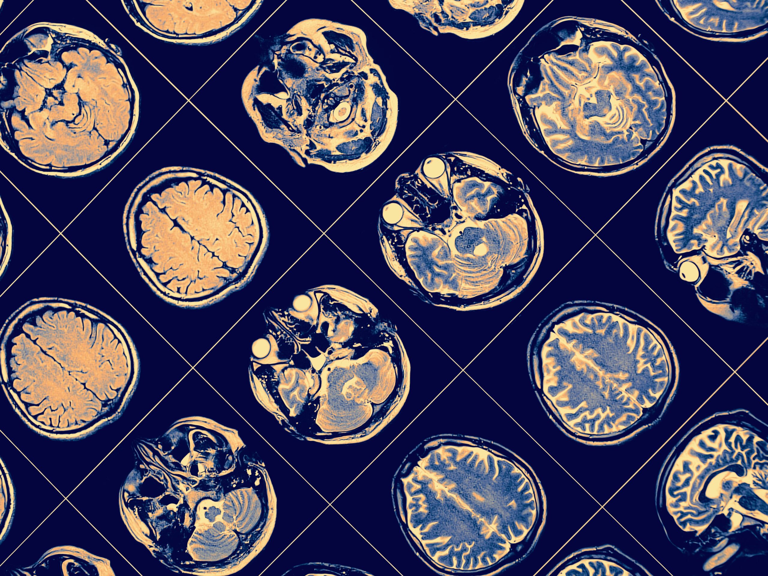 Droga para Alzheimer, lecanemab, é aclamada como avanço importante